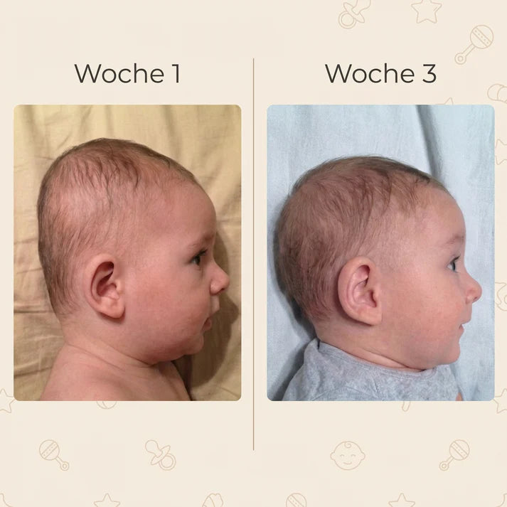 Vorher-Nachher: Kopfform Baby Woche 1 vs. Woche 3